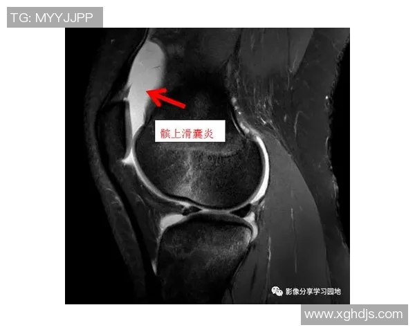 克勒贝尔训练意外受伤股四头肌拉伤将进行MRI检查